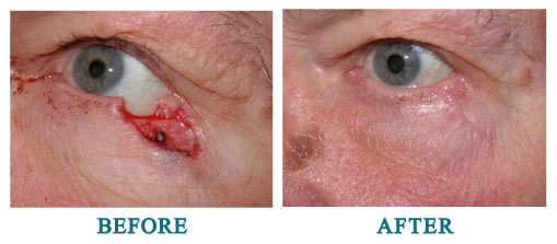 Repair of surgical defect from Mohs excision of basal cell carcinoma